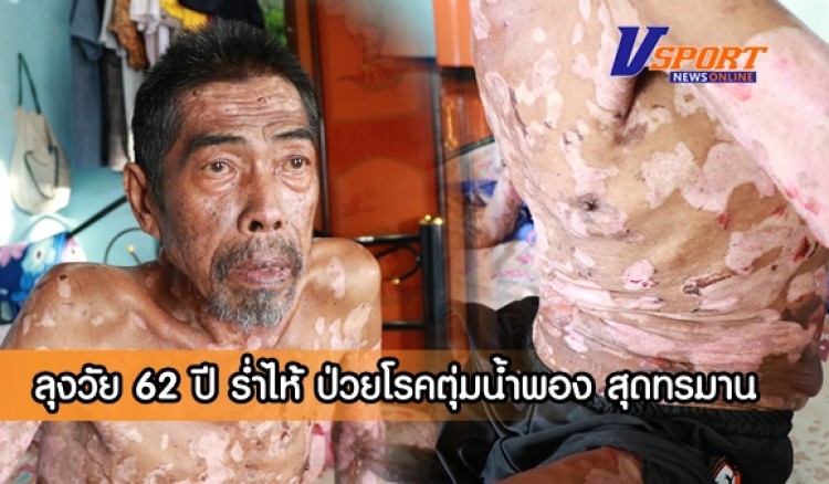 กำแพงเพชร-ลุงวัย 62 ปีป่วยโรคตุ่มน้ำพอง สุดทรมานร่ำไห้อยากรักษาให้หายเผยทรมานกับโรคนี้มากว่า 20 ปีแถมมียังมีโรครุมเร้าอีกหลายโรค วอนสังคมช่วยด้วย     